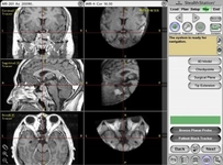 Hipofiz Mr Neden Çekilir?