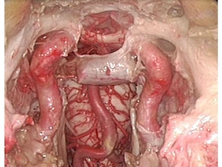 Hipofiz Ameliyatı Nasıl Yapılır?