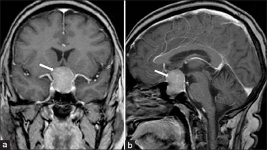 Hipofiz Gland